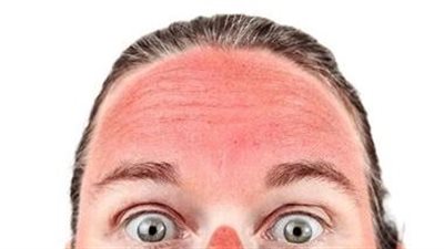 أضرار تسببها أشعة الشمس لأصحاب البشرة الدهنية 