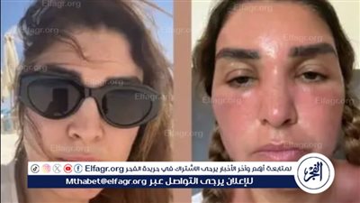 تحذير من مخاطر التعرض للشمس دون وقاية.. الفنانة روجينا تروي تجربتها 