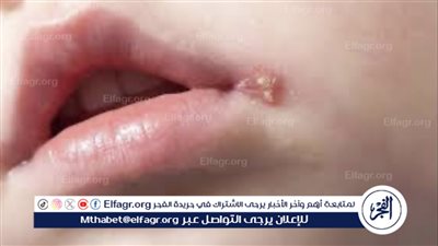 التعامل مع فيروس الهربس لدى الأطفال خلال فصل الصيف: الأعراض والوقاية والعلاج الطبيعي