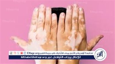 طبيب جلدية يكشف أهم أسباب الإصابة بمرض البهاق (فيديو)