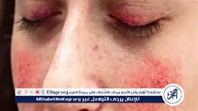 المحليات الصناعية سبب رئيسي للإصابة بالذئبة