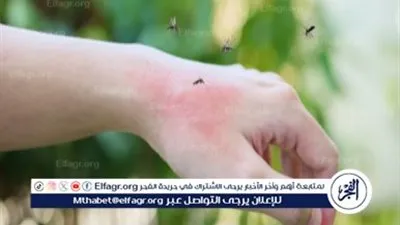 بعد زيادة أعداد المصابين في السودان.. كل ما تريد معرفته عن حمي الضنك