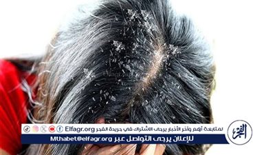 أسباب قشرة الشعر في الصيف وطرق طبيعية لعلاجها