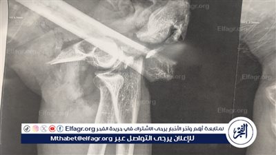 فريق طبي بمستشفى سوهاج الجامعي ينقذ ذراع سيدة من البتر مصابة بآلة حادة 