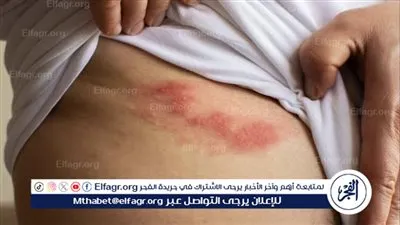 ما هو الحزام الناري؟ وكيف يمكن علاجه والوقاية منه؟