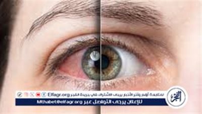أسباب جفاف العين عند الاستيقاظ.. طرق لحماية عينيك من الجفاف