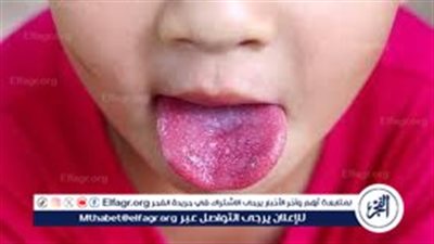 الحبوب الحمراء على لسان الطفل.. الأسباب والعلاج