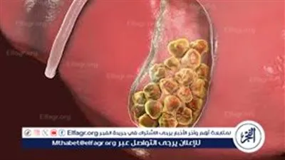 تشخيص حصى المرارة.. أعراضها وأسبابها وعلاجها