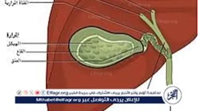 التهاب المرارة.. تعرف على الأعراض والعلاج