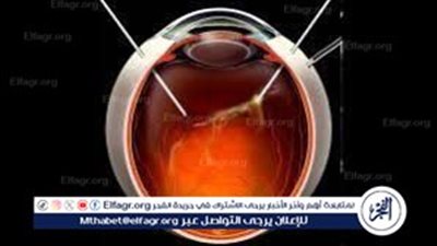 عملية استئصال زجاجية العين.. الإجراءات والأهداف