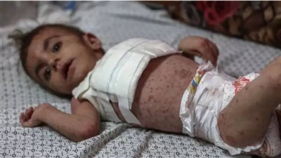 تقرير.. انتشار الأمراض الجلدية وسط الأطفال بمخيمات قطاع غزة