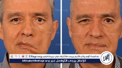 طبيب: الزعل من أسباب الإصابة بشلل العصب السابع