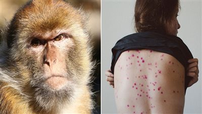 بعد تحذير الصحة العالمية.. اعرف أسباب وأعراض جدري القرود