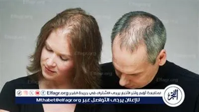 اعرف طرق علاج الصلع الوراثي