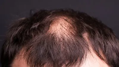 الصلع الوراثي: أسبابه، أنماطه، وطرق العلاج