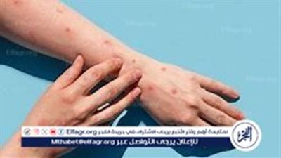 فيروس «M Pox» المعروف سابقًا باسم «جدري القرود».. تنشيط الإجراءات الصحية الوقائية