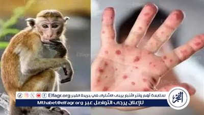 إعلان حالة طوارئ صحية بسبب جدري القردة.. تعرف على اللقاحات المستخدمة لمكافحة جدري القردة
