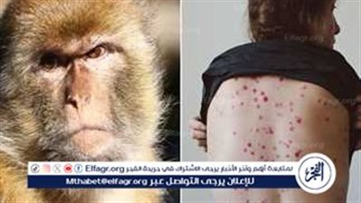 طرق علاج جدري القرود (M Pox) والإجراءات الوقائية