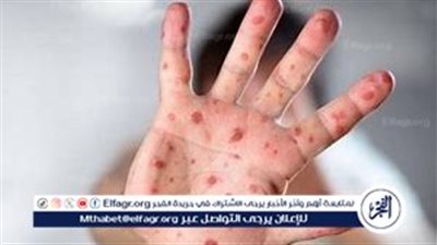 وزارة الصحة المصرية تعزز الإجراءات الوقائية لمكافحة مرض «M Pox» جدري القرود