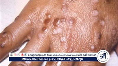 جدري القرود.. ما طبيعته وكيفية الوقاية منه