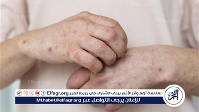 بعد انتشار جدري القرود.. ليلى عبداللطيف تقلب الموازين بعد توقعاتها بـ 