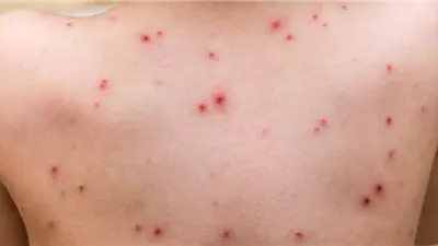 هل يتفشى جدري القرود بشكل واسع عالميًا؟