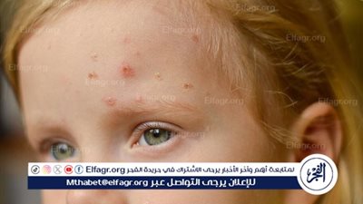 أعراض الإصابة بجدري القردة وكيفية التعرف عليها