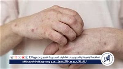 الصحة توضح توافر لقاح جدري القرود في مصر