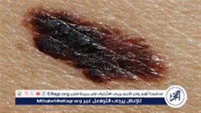 كيفية الكشف المبكر عن سرطان الجلد: علامات تحذيرية يجب مراقبتها