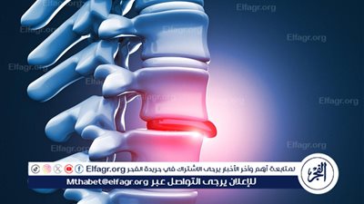 الإنزلاق الغضروفي: الأسباب، الأعراض، والعلاج