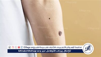 الشامات وسرطان الجلد.. كيفية التمييز والعلاج الأمثل