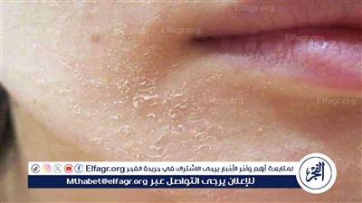 روتين العناية بالبشرة الجافة خلال فصل الصيف