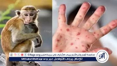 المصل واللقاح: لم يتم رصد حالات مصابة بـ جدري القرود.. ومصر يقظة