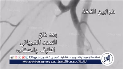 إنجاز طبي جديد لعلاج شرايين 
