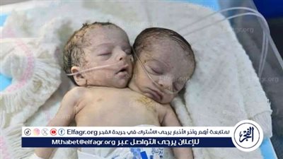 عاجل - ولادة توأم برأسين.. حالة نادرة تجذب الانتباه ولكن النهاية مأساوية (شاهد الصور والتفاصيل)