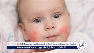 استشاري أمراض جلدية يوضح أهم أعراض الإصابة بالأكزيما التأتبية (فيديو)