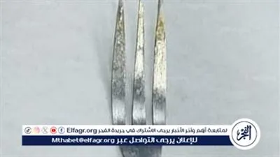 فريق طبي بمستشفى جامعة طنطا ينجح في استخراج شوكة معدنية من معدة سيدة 