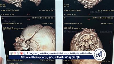 تفاصيل إجراء جراحة نادرة لفصل 