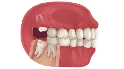 حشو ضرس العقل: هل هو الحل الأمثل ؟