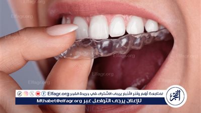 التقويمات السنية: أنواعها وفوائدها لصحة الفم