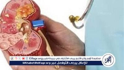 حصوات الكلى: الأعراض، الأسباب، والعلاج