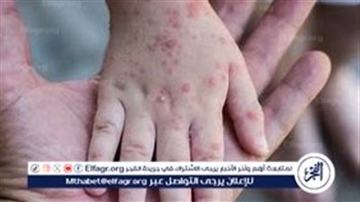 اكتشاف متغير جديد من جدري القرود يثير حالة طوارئ صحية عالمية