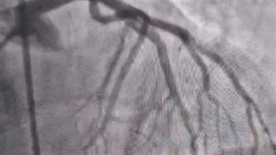 صحة المنوفية: إنقاذ حياة مريض بعد توقف القلب في مستشفى منوف العام