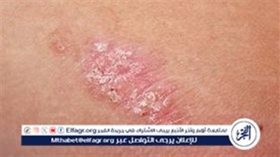 مرض الصدفية.. أعراضه وعلاقته بالنوبات القلبية وطرق العلاج