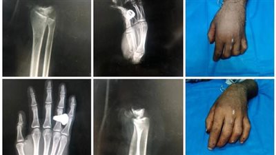 فريق طبي بجامعة أسيوط ينجح في زراعة يدان لشاب بعد تعرضهما للبتر