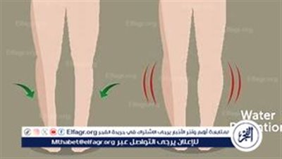 احتباس الماء في الجسم: الأسباب والأعراض وطرق العلاج
