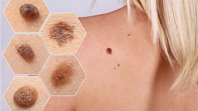 سرطان الجلد: التأثير الخفي للأشعة وتحديات الوقاية 