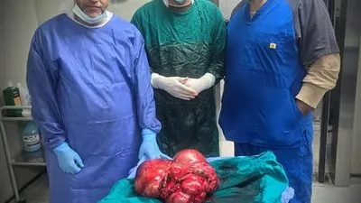 مستشفى بنها للتأمين الصحي: استئصال ورم ضخم يزن 9 كيلوجرامات