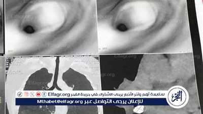 فريق طبي بجامعة أسيوط ينجح في إجراء عملية جراحية دقيقة لاستخراج جسم غريب من الشعب الهوائية لفتاه من قنا 