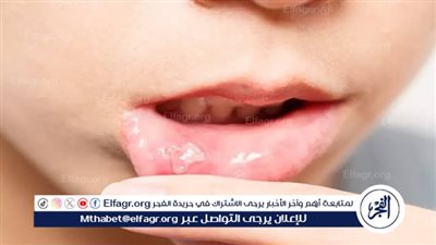 أفضل العلاجات المنزلية للتخلص من قرح الفم.. طرق طبيعية فعّالة لتخفيف الألم وتسريع الشفاء